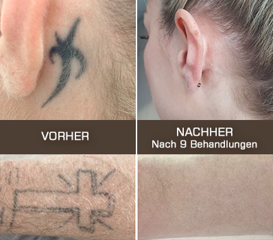 Dr. Klaudia Hauer Tattooentfernung